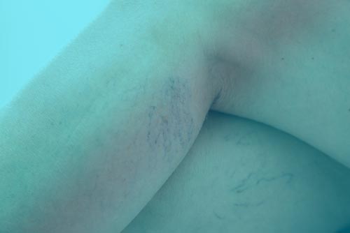 Sclerotherapy is spider vein treatment in Gastonia North Carolina