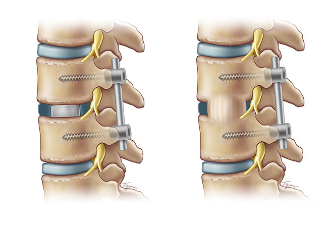 What Is Spinal Fusion Surgery NSSC Back Pain Spine Specialists 