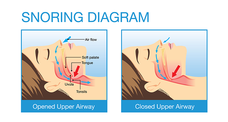 ema device for sleep apnea